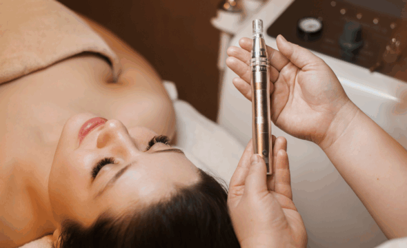  The Benefits of Microneedling for Acne Scars and Fine Lines 