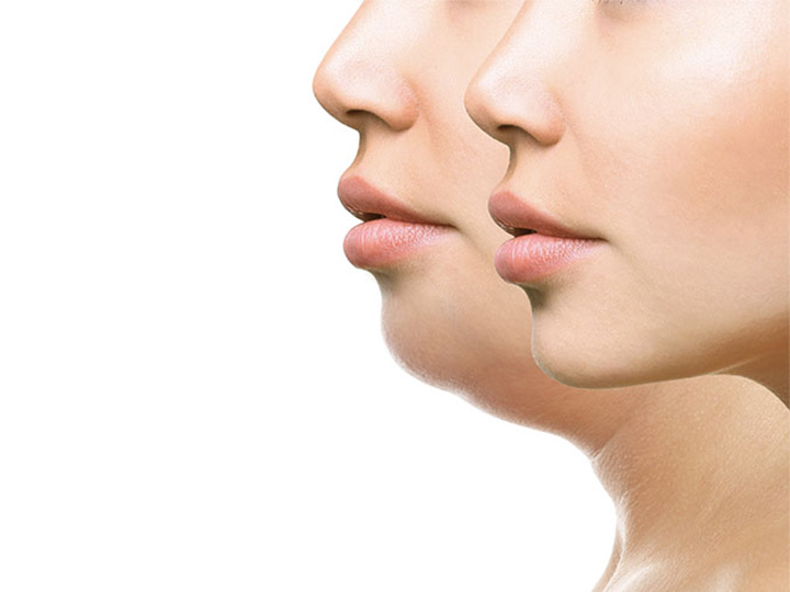 Double Chin Removal with Kybella Wellington FL