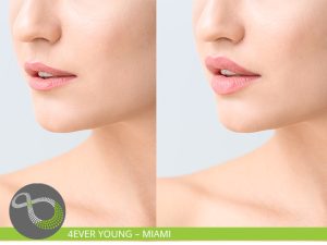Lip Enhancement Miami FL