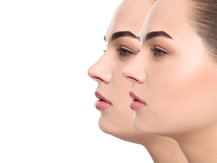Double Chin Removal with Kybella Plantation FL