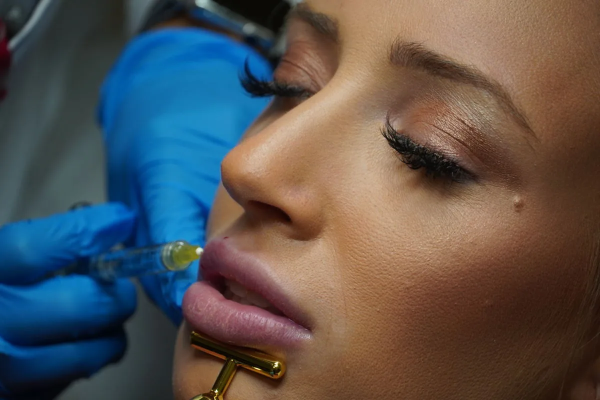 A gloved provider injects hyaluronic acid filler into a patient's upper lip